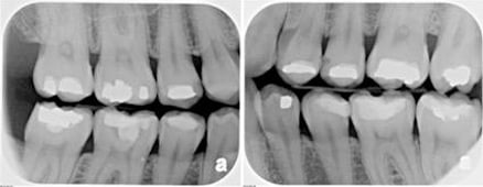 Bitewing X-Rays