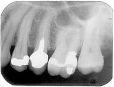 Periapical X-Ray